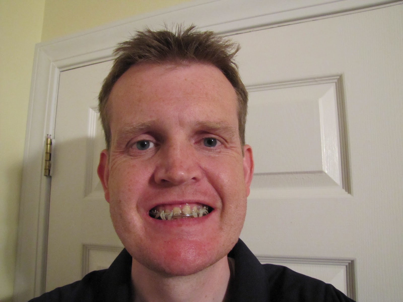 Double Jaw Operation The Road to Recovery