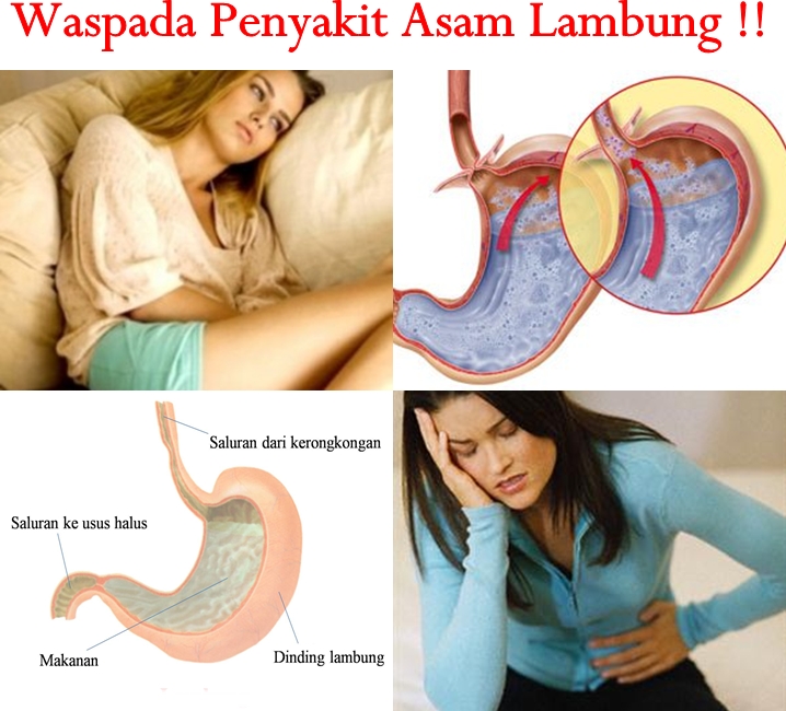 Obat Tradisional Asam Lambung