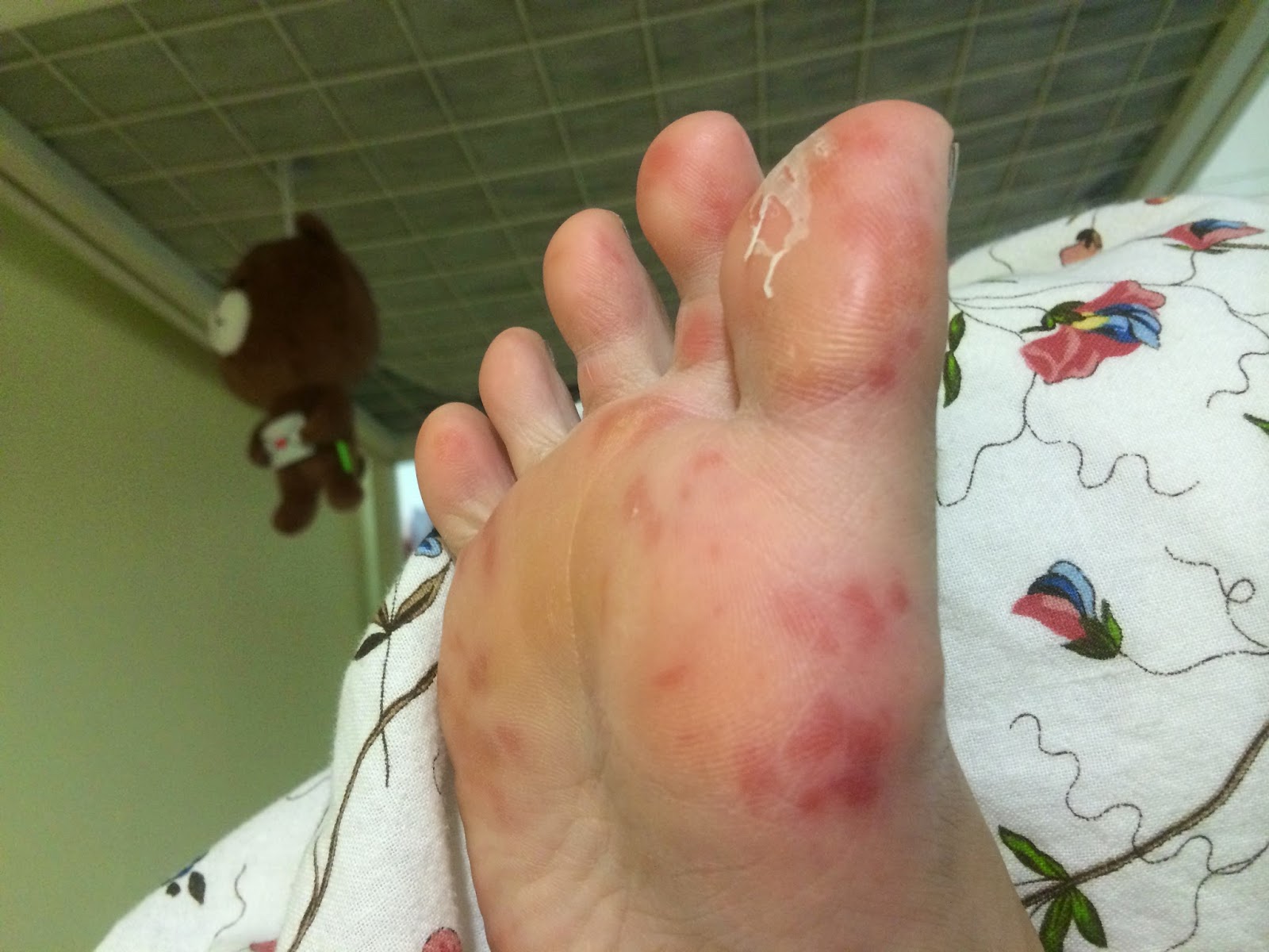 The Dettol Diaries: HFMD Timeline