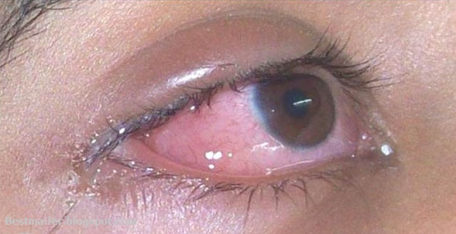 Conjunctivitis-signs and symptoms