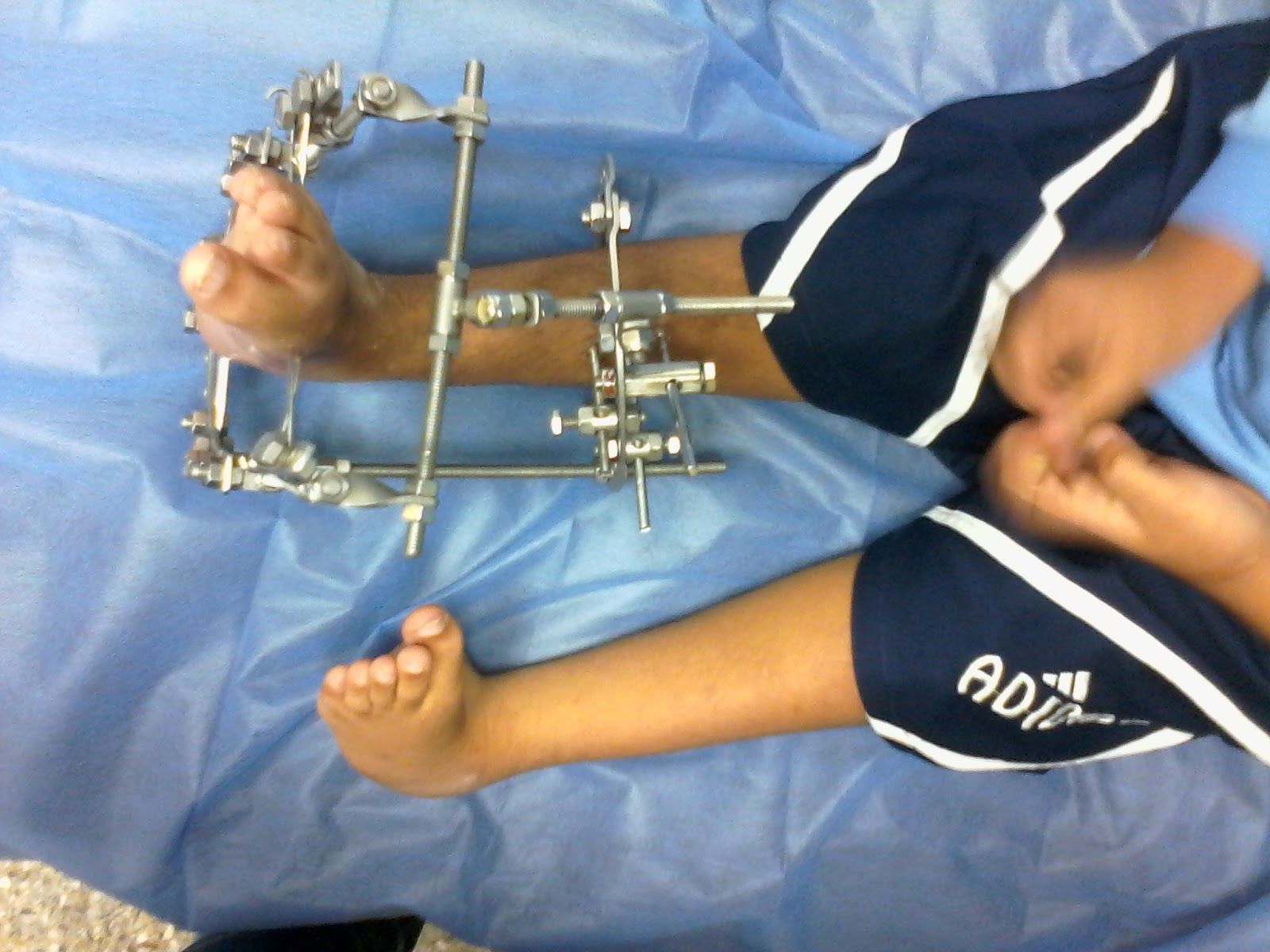 CIRUGIA ORTOPEDICA RECONSTRUCTIVA DE MIEMBROS INFERIORES * * * * C. O