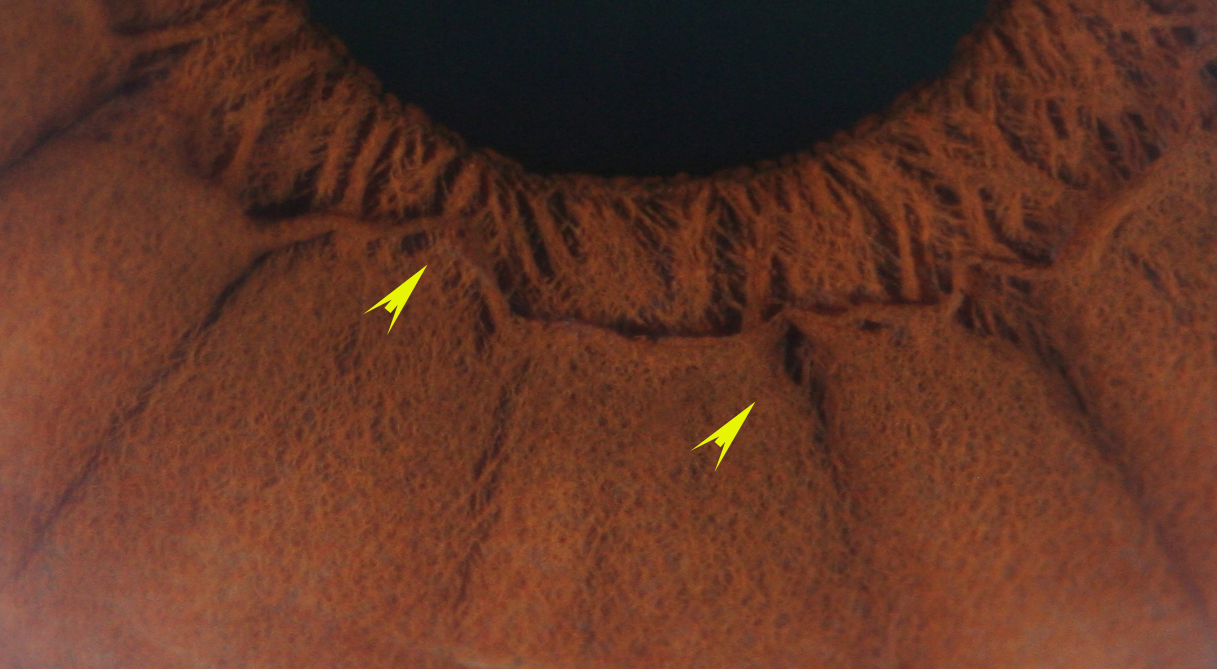 Modern & Multidimensional Iridology The Collarette Structure & Signs