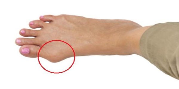 Get Rid of Bunions in a Natural Way Without Going Under the Knife Bunions