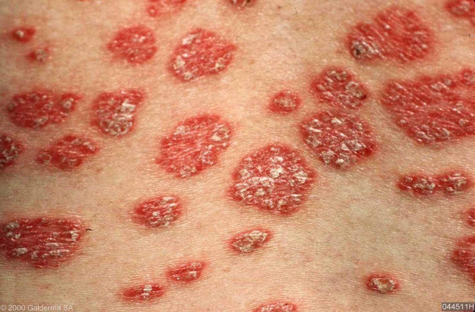 SKIN DISEASE TYPES Guttate Psoriasis