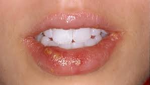 How to heal blistered chapped lips