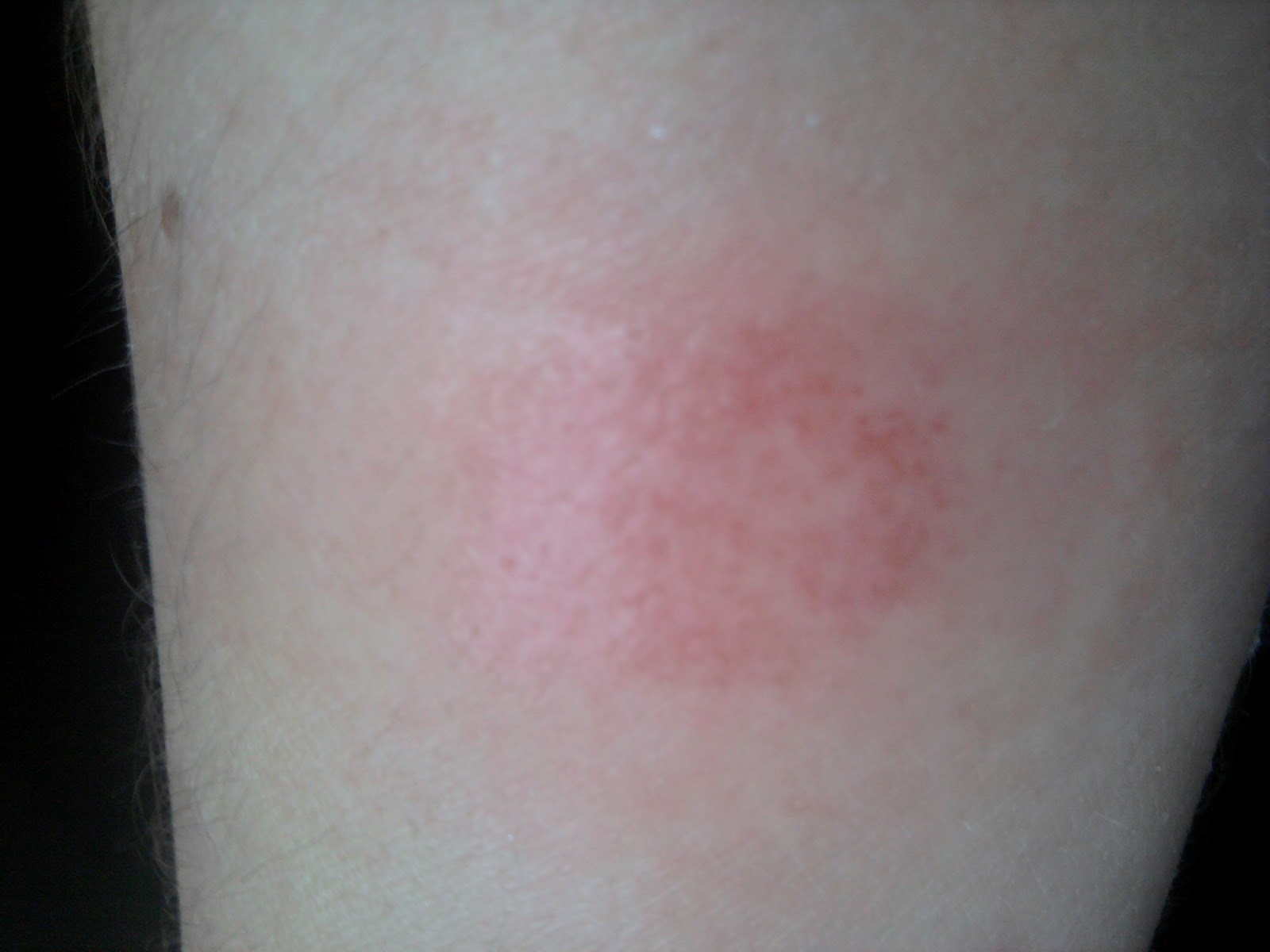 What's the what? Ringworm