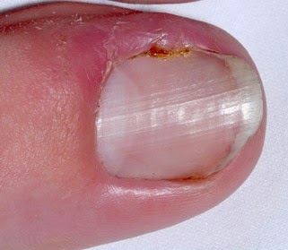 Las uñas amarillas el tratamiento en las manos