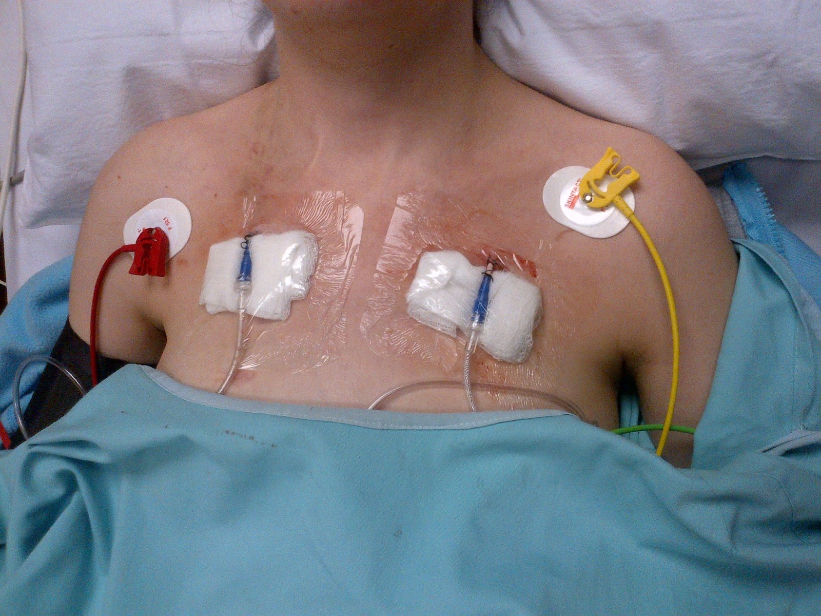 Deer Diary Punctured Lungs