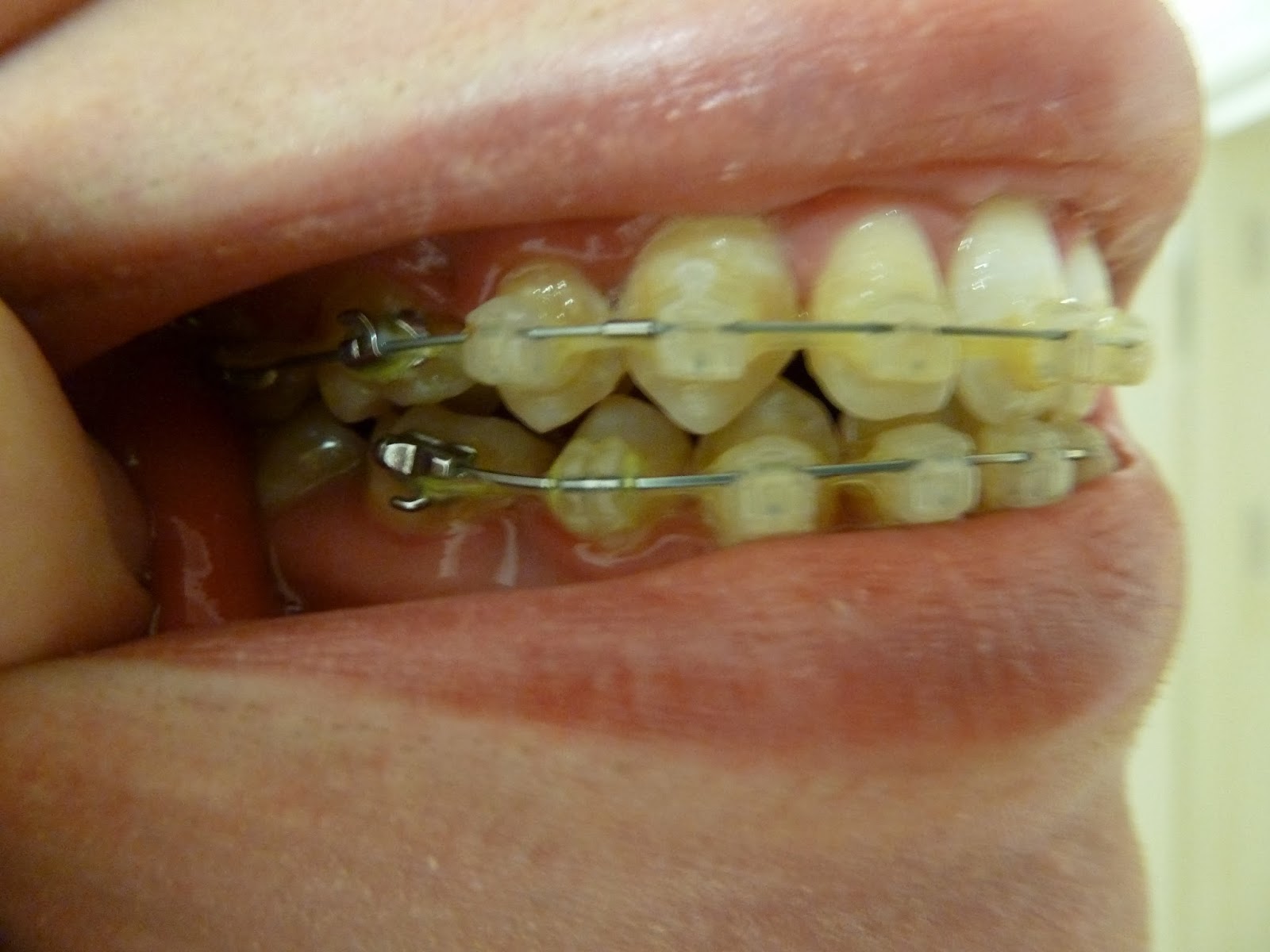 braces yellow teeth week treatment chains