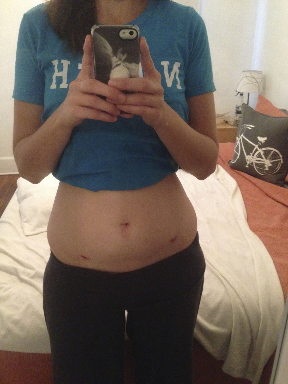 The Snarky Writer Getting My Laparoscopic Bilateral Salpingectomy