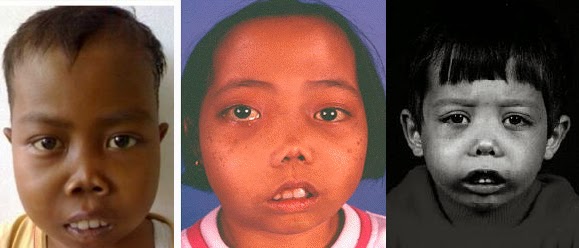 Just Share What I Know From Thalasemia August 2014 Just Share What I Know From Thalasemia August 2014