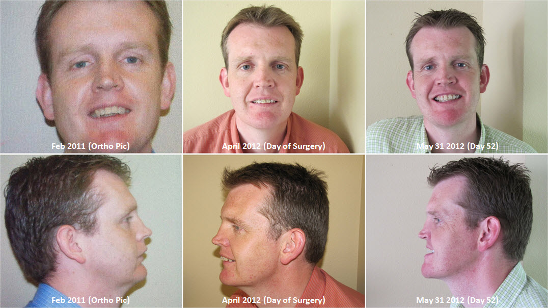 Double Jaw Operation The Road to Recovery