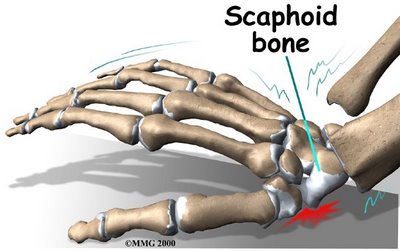 scaphoid fracture