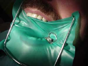 dental-dam1.jpg