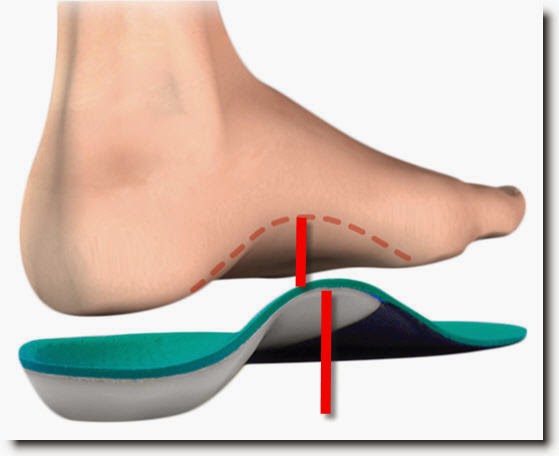 plantar fasciitis without heel pain