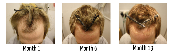 Does propecia regrow receding hairline Does propecia regrow receding hairline