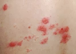What is the incubation period for shingles | Tips Curing Disease
