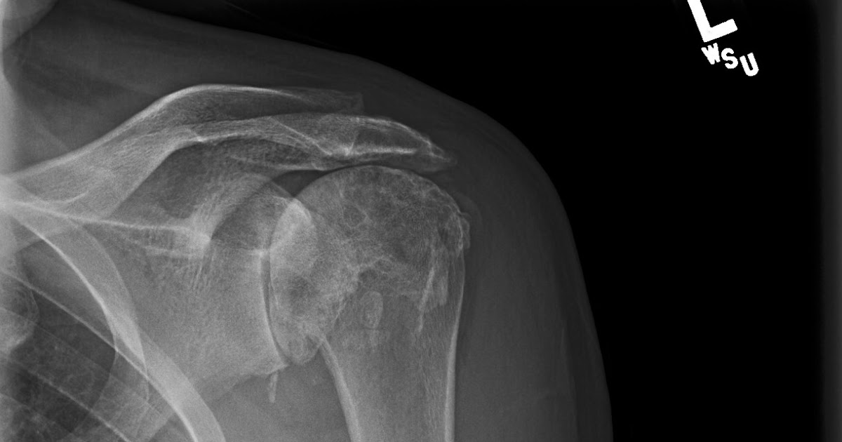 Shoulder Arthritis / Rotator Cuff Tears: causes of shoulder pain