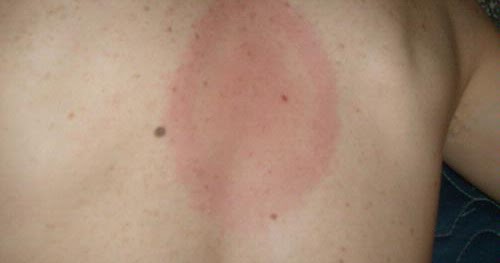 symptomer på borrelia symptomer på borrelia