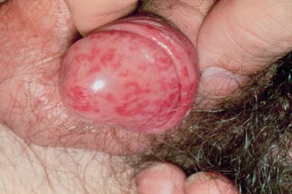 Penyakit Herpes Kelamin