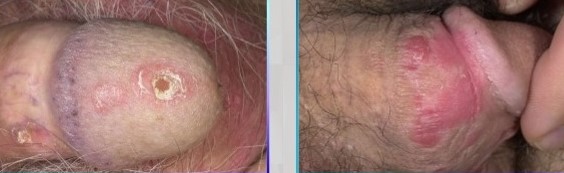 Doktor Piton Tansiyon Ilazlari Cinselligi Etkilermi Tadalafil Hangi Bitkilerde Bulunur Maxman Hap