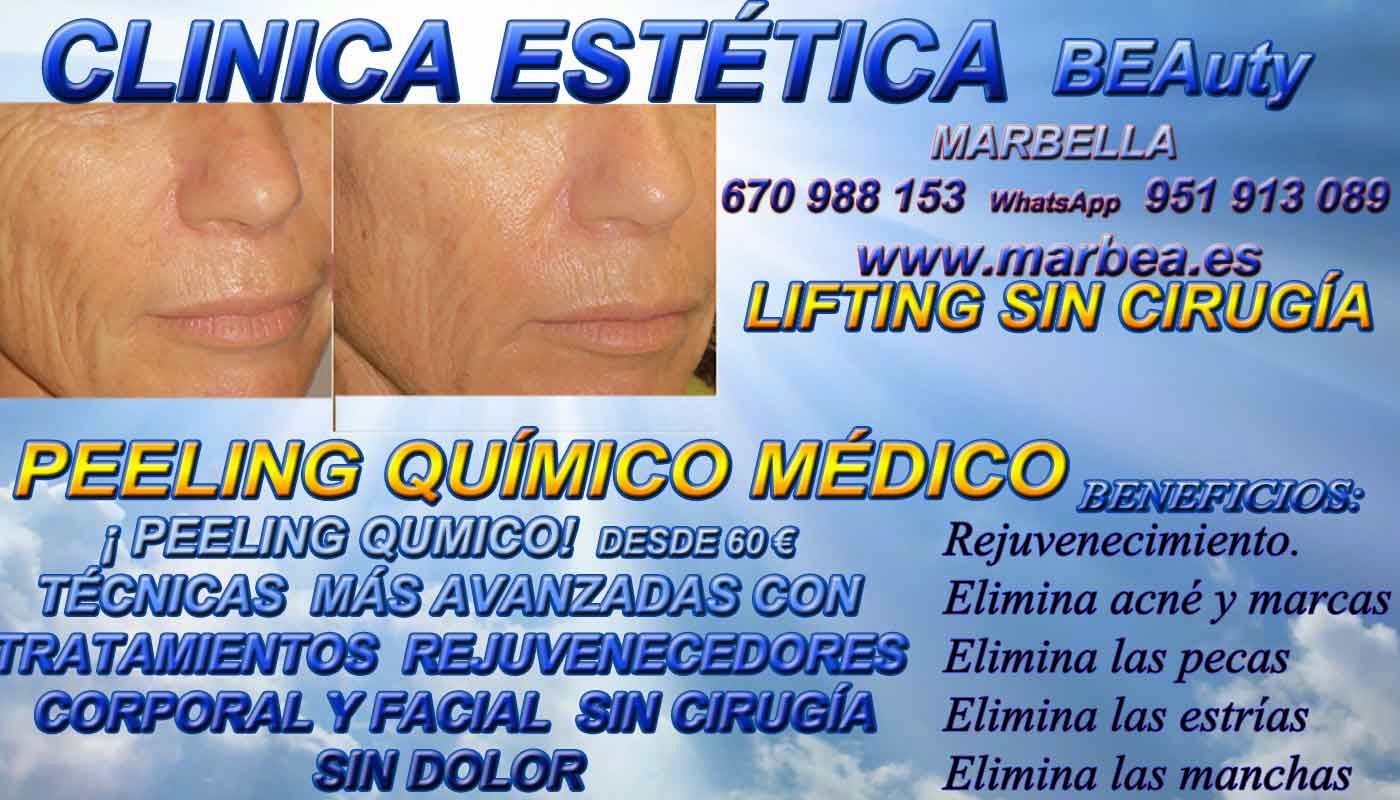MARBELLA PEELING FACIAL QUIMICO  MARBELLA PEELING FACIAL QUIMICO MEDICO PARA ELIMINACIÓN , QUITAR , TRATAMIENTO: ACNÉ , MARCAS , CICATRICES , MANCHAS ,PECAS , ESTRÍAS , MANCHAS