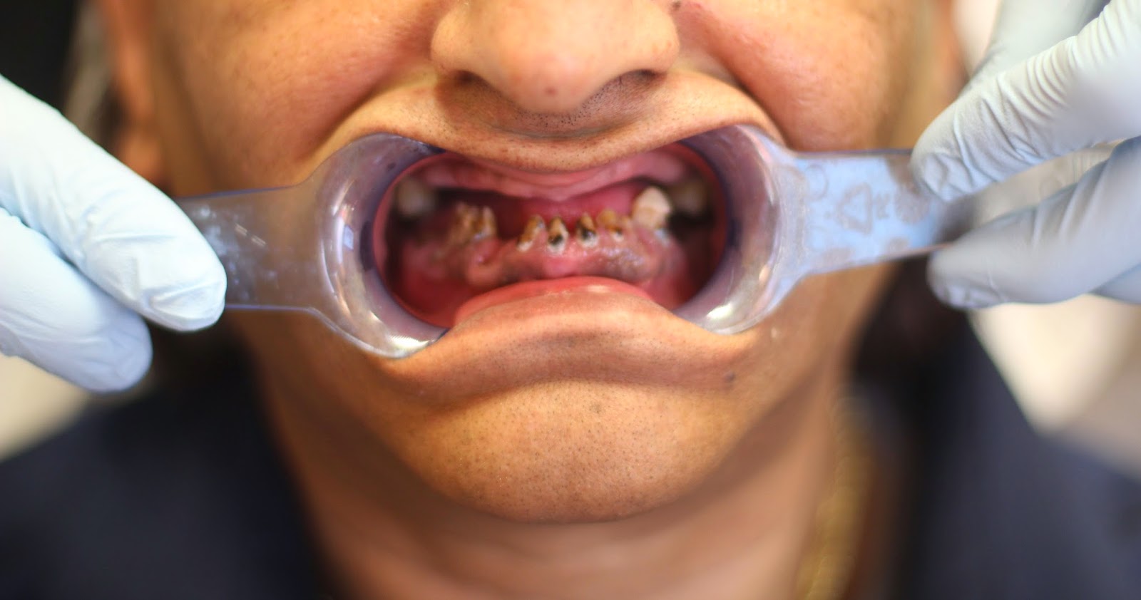 Golpa Dental Implant Center of Las Vegas G4 Implant Solution Dental