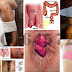 Metode Pengobatan Wasir Yang Aman dan Manjur thumbnail