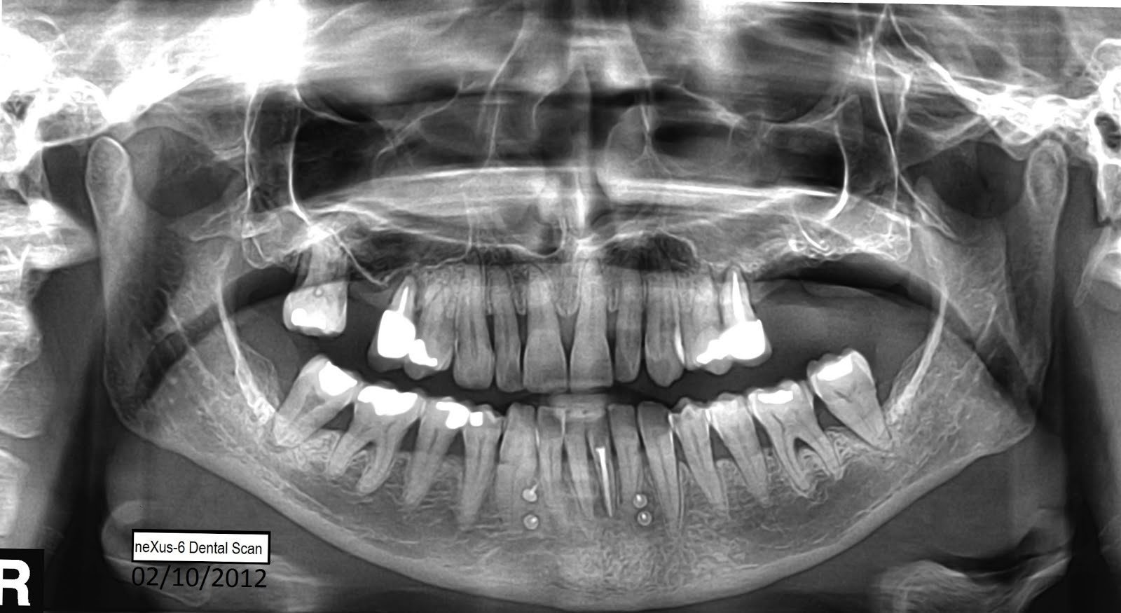 neXus6 Dental Scan Centre OSTEOPOROSIS