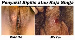 gambar sipilis pria dan wanita