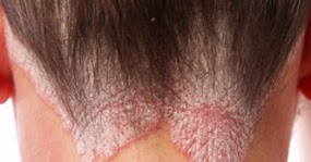 Los preparados para el tratamiento de la psoriasis en el cuerpo