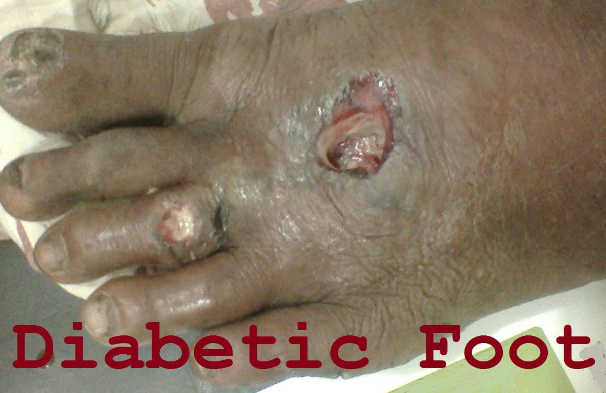 a look at the disease diabetes mellitus Patients with type 1 diabetes mellitus (dm) require lifelong insulin therapy most require 2 or more injections of insulin daily, with doses adjusted on the basis of. a look at the disease diabetes mellitus Patients with type 1 diabetes mellitus (dm) require lifelong insulin therapy most require 2 or more injections of insulin daily, with doses adjusted on the basis of.