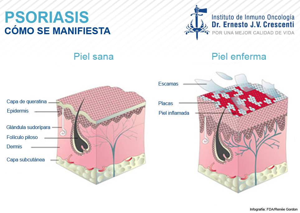 Que se distingue rosado priva de la psoriasis