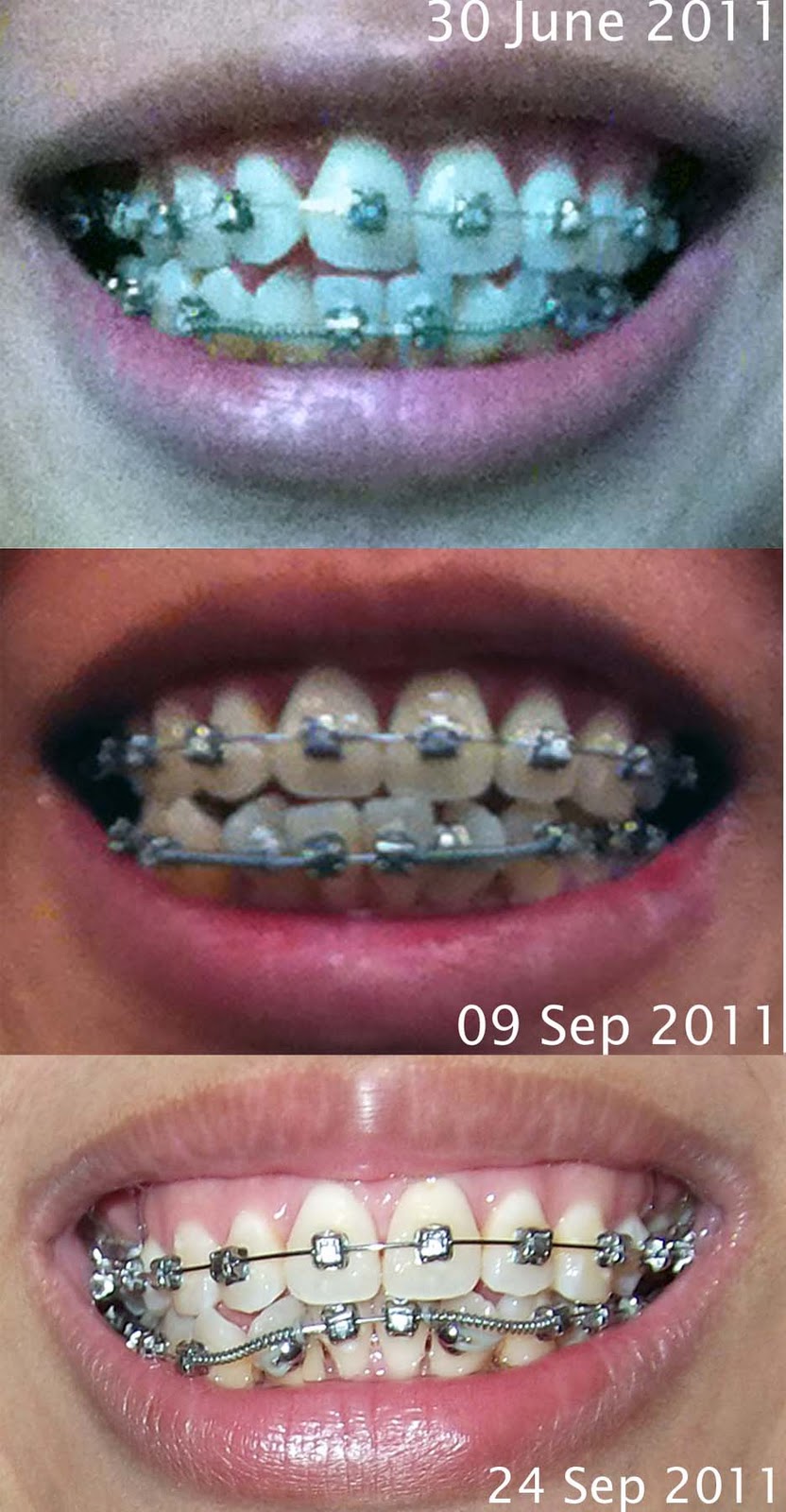 Braces Progress Photos