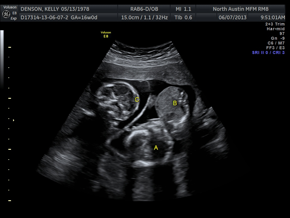 The Texas Trio A Triplet Pregnancy Blog 16 week ultrasound pics