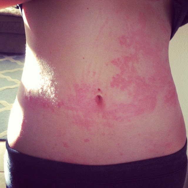 How To Get Rid Of Hives Naturally