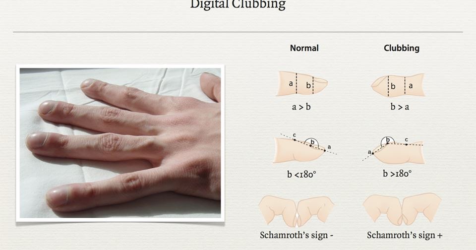 Naut's Medical Tips Clubbing of Fingers