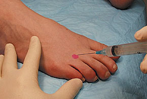 Plantar fasciitis local steroid injection