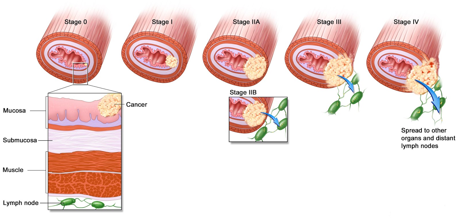 Esophageal Cancer Staging Chart
