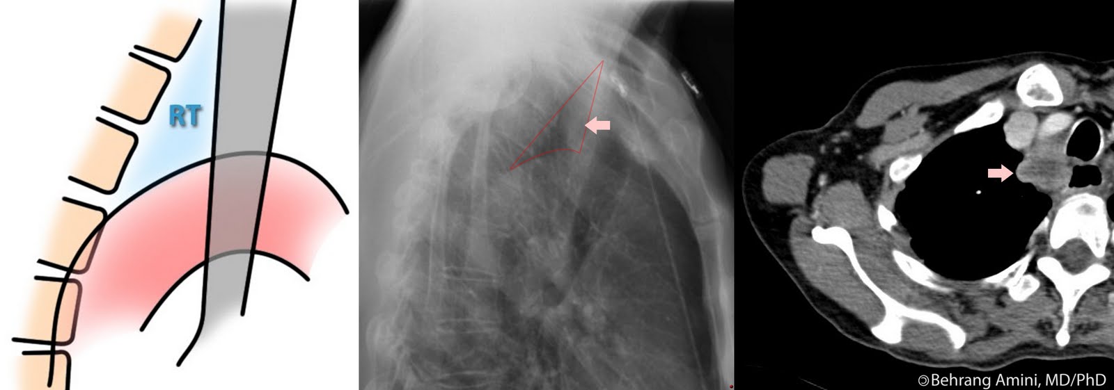 Roentgen Ray Reader Retrotracheal Triangle