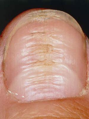 Horizontal ridges in the nail can indicate a fungal infection or