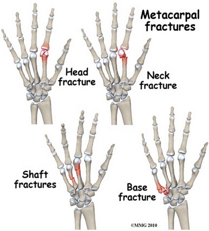 Radiology Archives Λοξό Κάταγμα Διάφυσης 4ου Μετακαρπίου