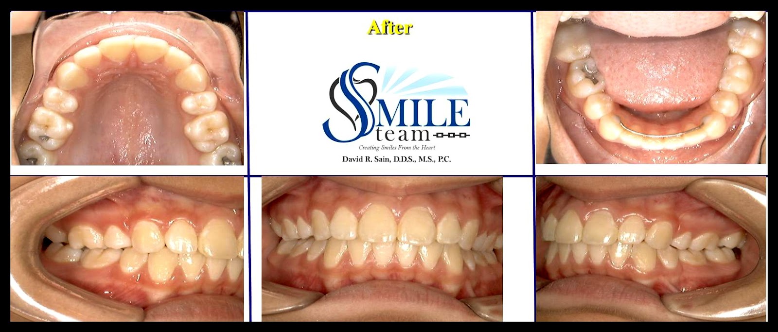 Smile Team Orthodontics What is a Jaw Corrector (Herbst Appliance) and