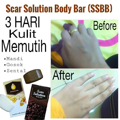 Testimoni Scar Solution Body Bar (SSBB)