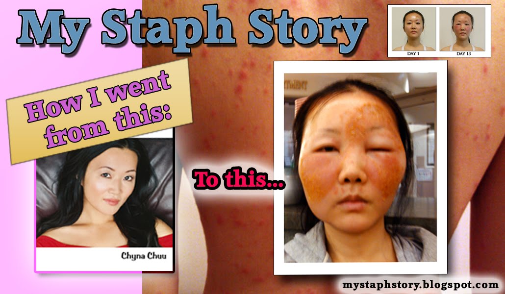 My Staph Story