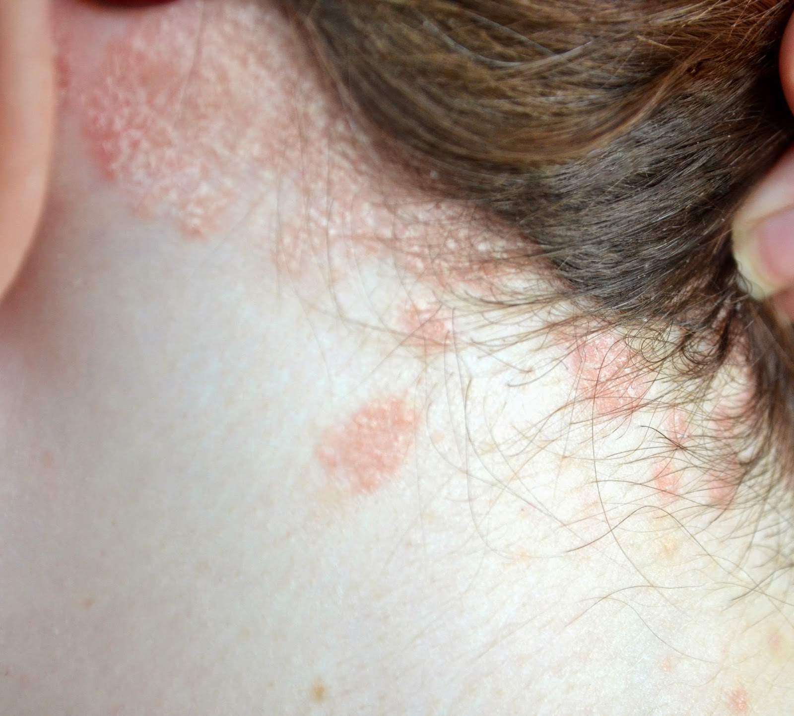 Dermasolve Scalp Itch Shampoo Review with Before and After Pictures