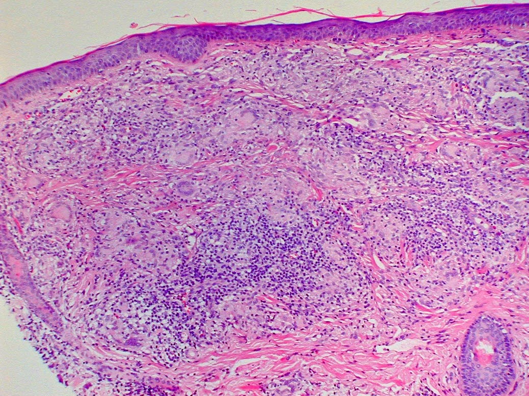 Differential Diagnosis in Dermatopathology TEST CASES