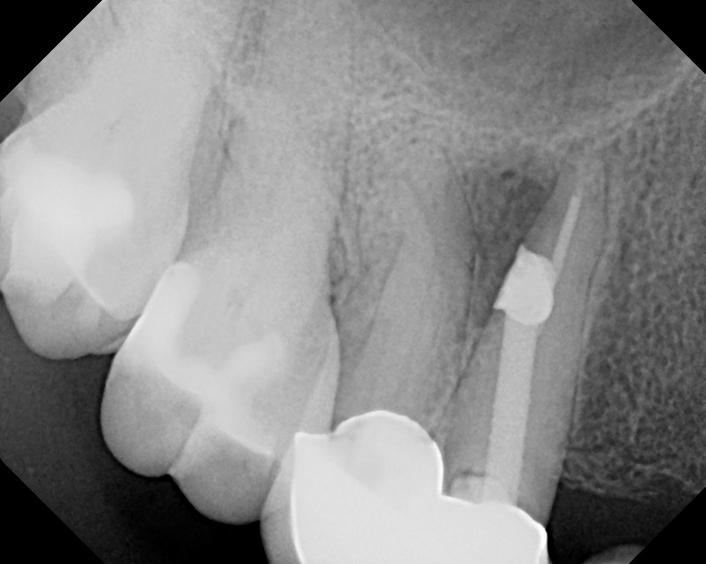 The Endo Blog Root Canal Surgery to Repair Post Perforation