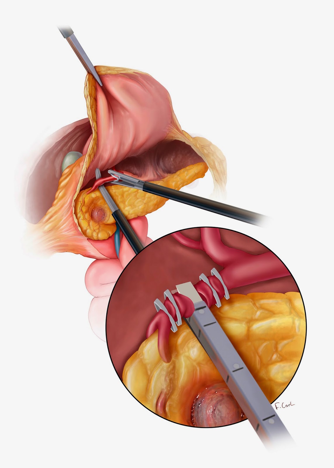 Corl Medical Media Laparoscopic Whipple Procedure, 2012