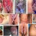 Obat Basmi Kutil yang Tumbuh di Alat Vital thumbnail